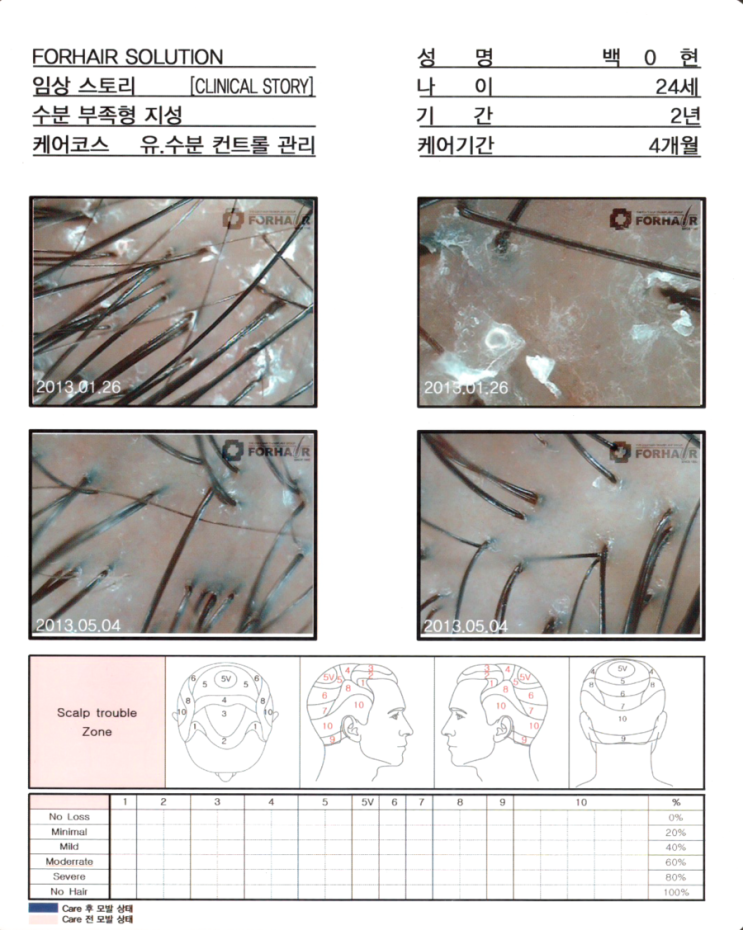 탈모기간 2년, 유,수분 컨트롤 관리 4개월 후 두피사진입니다.