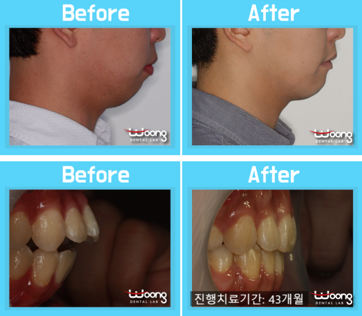  무턱치아교정 얼굴라인개선되다
