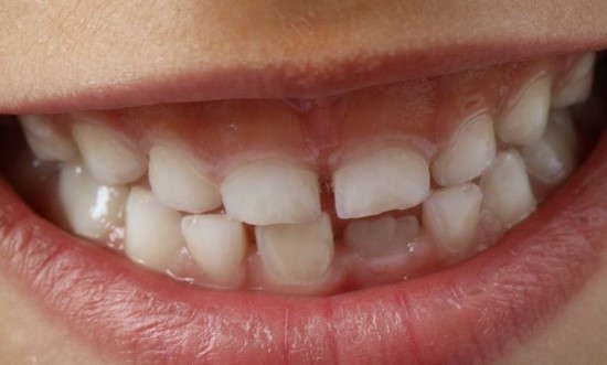앞니 모양이 불규칙적인 경우 치아성형으로 치과 치료를 받으실 수 있습니다.