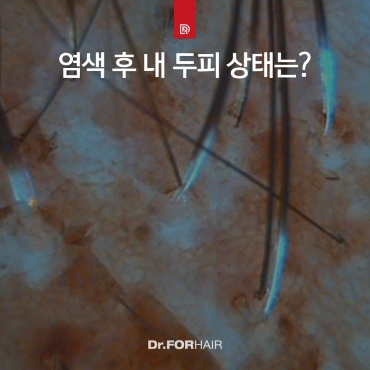 염색 후 내 두피 상태는?