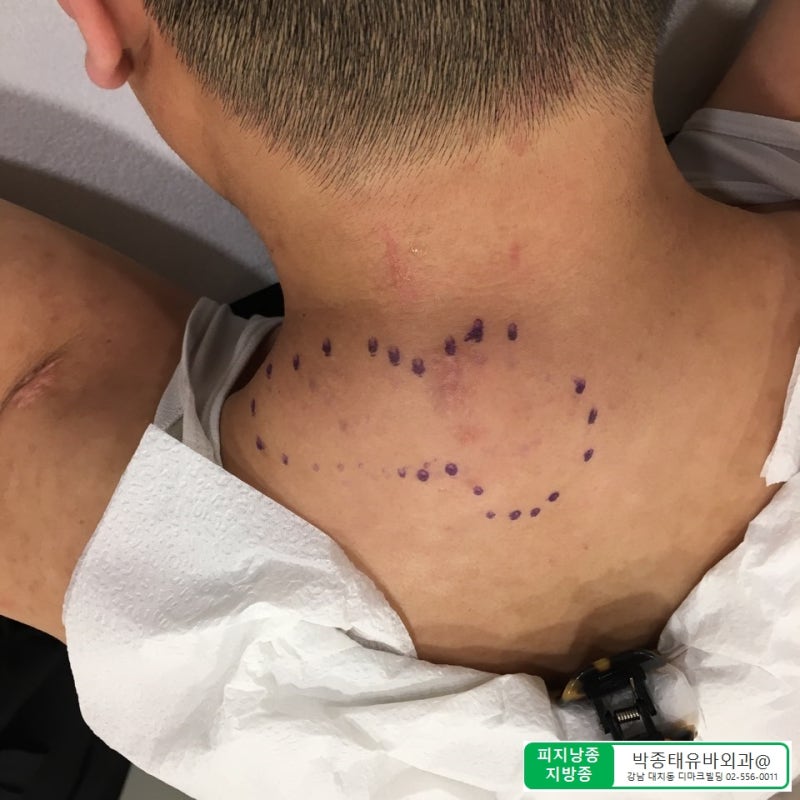 [Dr.ParK] 등 깊숙한 곳에서 혹이 만져집니다. 근막에 둘러싸인 지방종 제거 수술 11