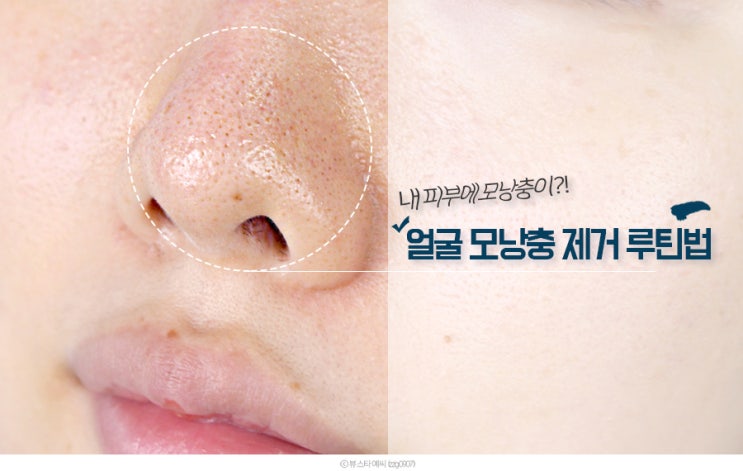  얼굴 모낭충 제거 이거 보면 바로 케어하게 될걸?
