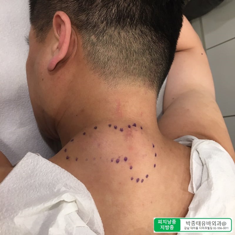 [Dr.ParK] 등 깊숙한 곳에서 혹이 만져집니다. 근막에 둘러싸인 지방종 제거 수술 8