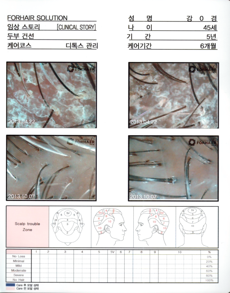 탈모기간 5년, 티톡스 관리 6개월 후 두피사진입니다. 탈모기간 5년, 티톡스 관리 6개월 후 두피사진입니다.
