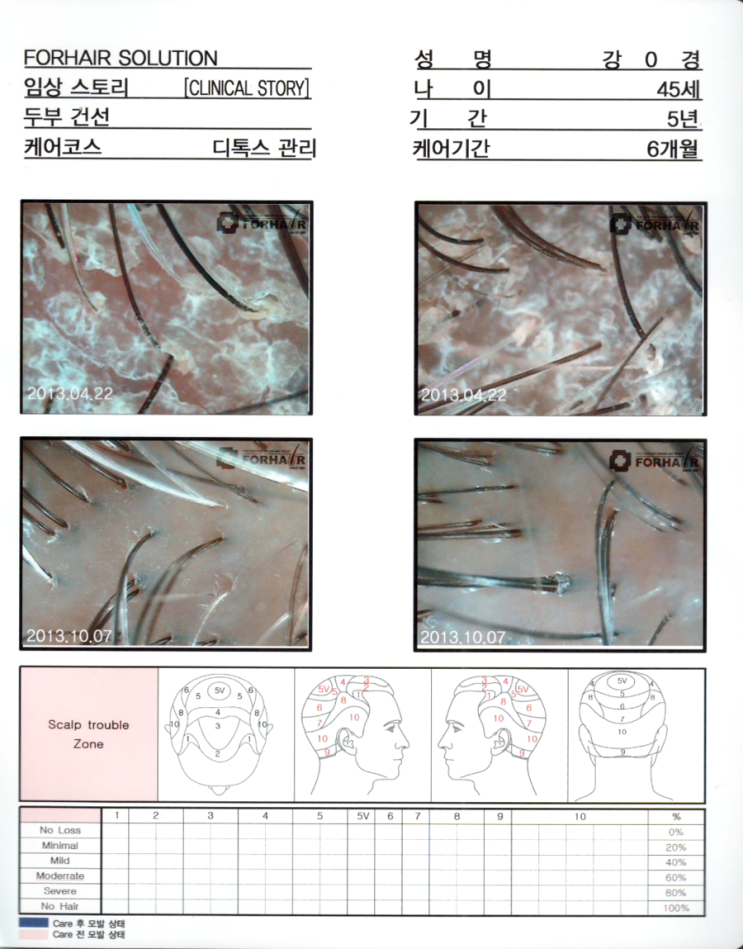 탈모기간 5년, 티톡스 관리 6개월 후 두피사진입니다.