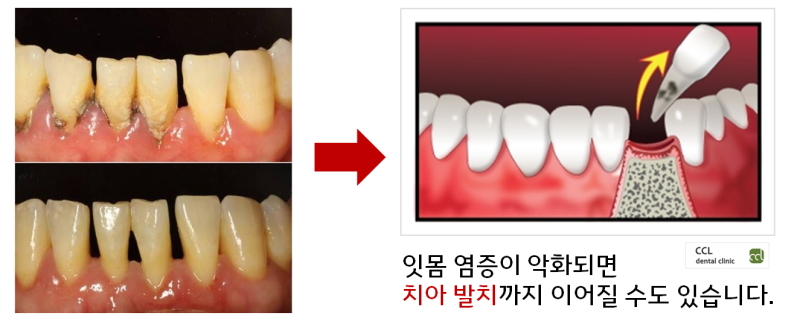 잇몸 부종과 통증/치은 염증 치료 방법의 비교 분석 6