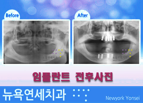 치아를 상실하고 난 후에 임플란트 수술만 잘 받으면 되나요?