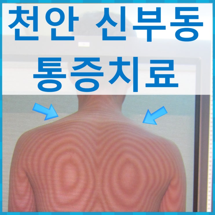  신부동 한의원 통증 : 승모근결림 치료중 참고