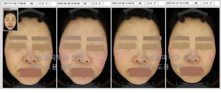  [삼성동피부과] 기미와 혼동되기 쉬운 양측성오타모반(ABNOM) 실제 치료 사례 - ST성모피부과