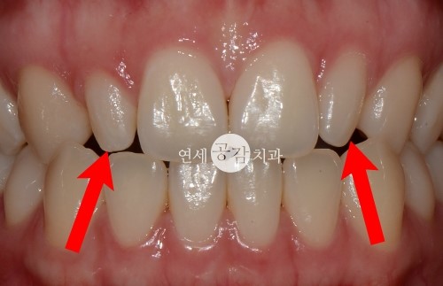  왜소치 라미네이트 vs 왜소치 레진 무엇을 해야 할까요?