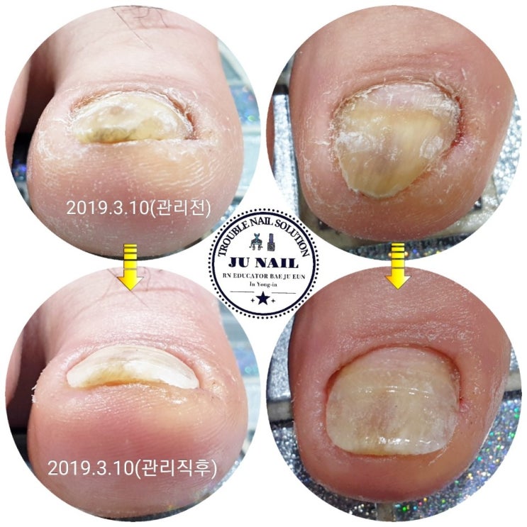 8년동안 내성발톱으로 아파서 계속 자르다보니 돌이킬수가 없었어요./분당용인수원수지보정동백죽전동/주네일/무좀파고드는발톱전문네일샵