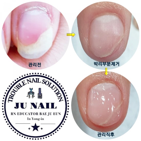 손톱이 하얗게 뜨면서 벌어졌어요(손톱조갑박리)/분당용인수원수지보정동백죽전동/주네일/무좀파고드는발톱전문네일샵 손톱이 하얗게 뜨면서 벌어졌어요(손톱조갑박리)/분당용인수원수지보정동백죽전동/주네일/무좀파고드는발톱전문네일샵
