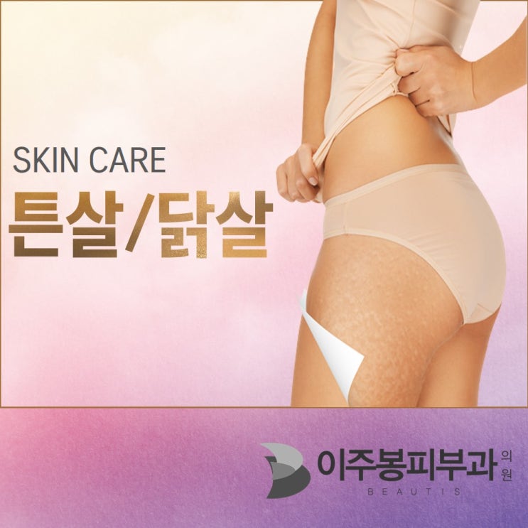  수원피부과추천 , 튼살/닭살은 이주봉피부과 !