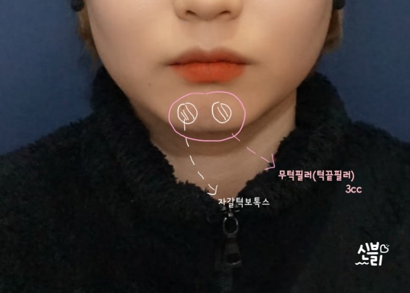 입술필러+무턱필러 자갈턱 보톡스 리뷰 팁 및 전후비교사진 9