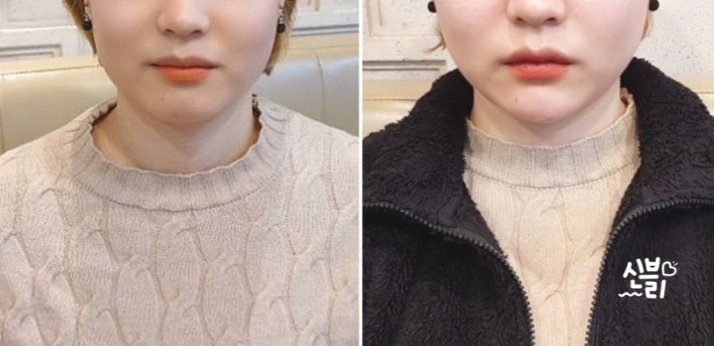 입술필러+무턱필러 자갈턱 보톡스 리뷰 팁 및 전후비교사진 4