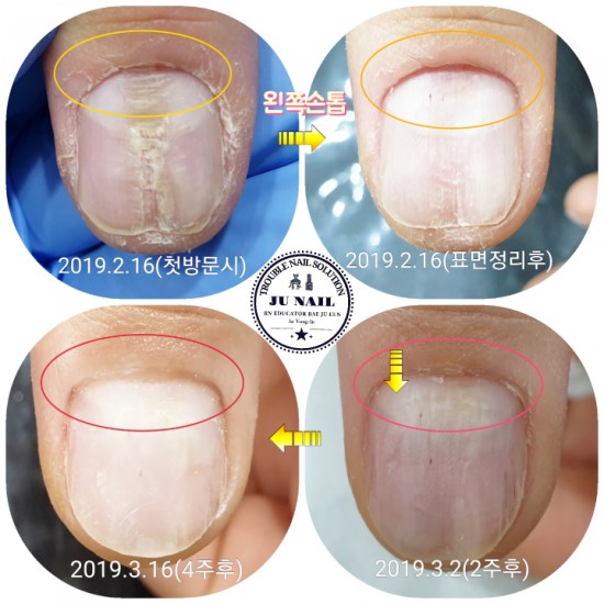 울퉁불퉁 물어뜯는손톱이변형됐어요.  이제는 고치고 싶어요.(빨래판손톱/워시보드네일) 한달만에 이정도로 좋아졌어요./분당용인수원수지보정동백죽전동/주네일/무좀파고드는발톱전문네일샵