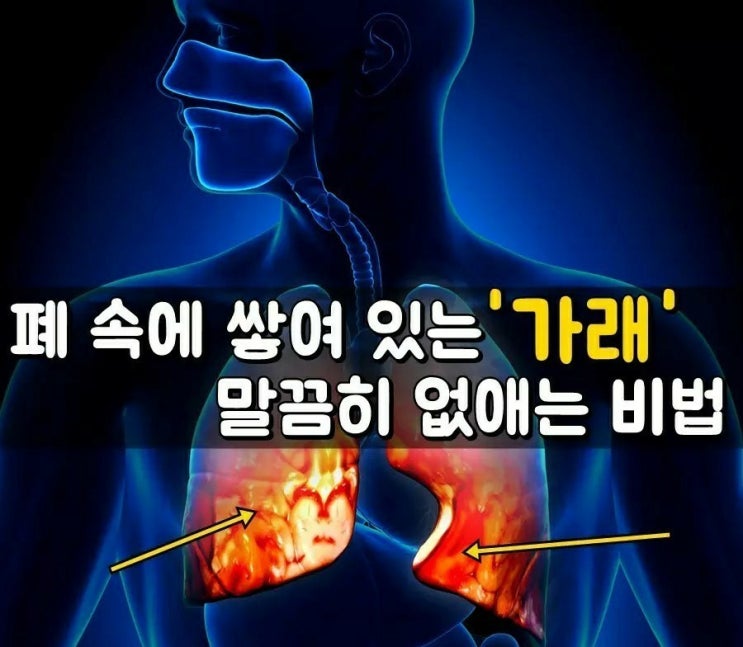 폐속의 가래가 생기는 원인 및 없애는 법