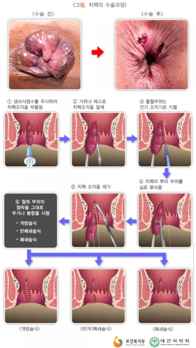대변에 피가 나오는 치질증상, 배변후에 항문 가려움, 통증, 출혈, 부어오름에 헤모렉스크림 덱스판테놀 비판텐 연고 급성치열 치료법은 자연치료(만성은 수술) : 네이버 블로그