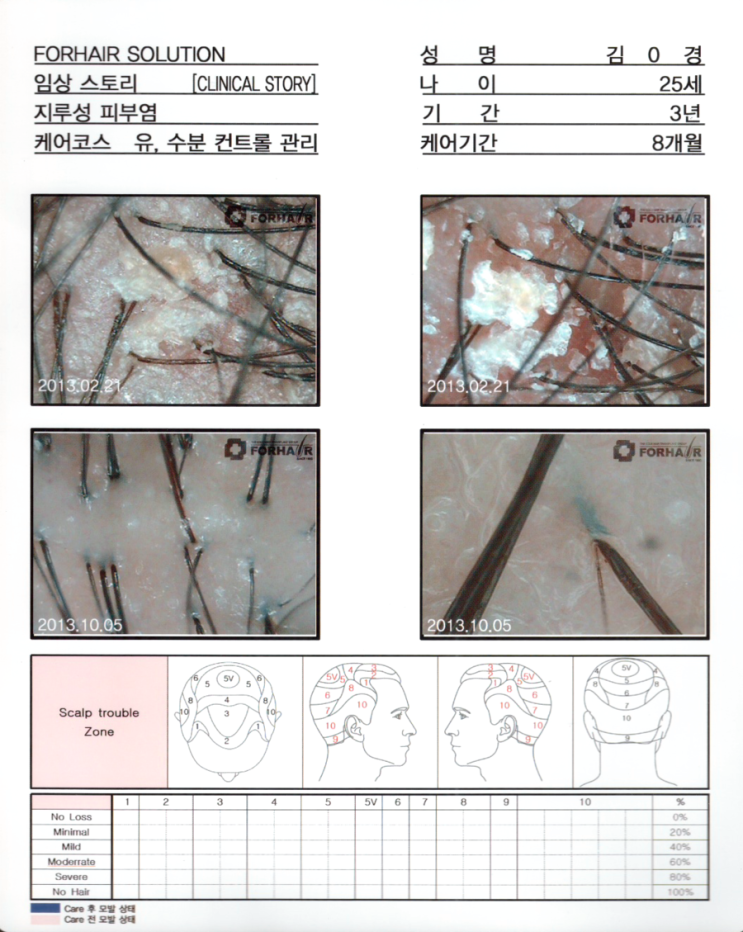탈모기간3년, 유,수분 컨트롤관리 8개월 후 두피사진입니다. 탈모기간3년, 유,수분 컨트롤관리 8개월 후 두피사진입니다.