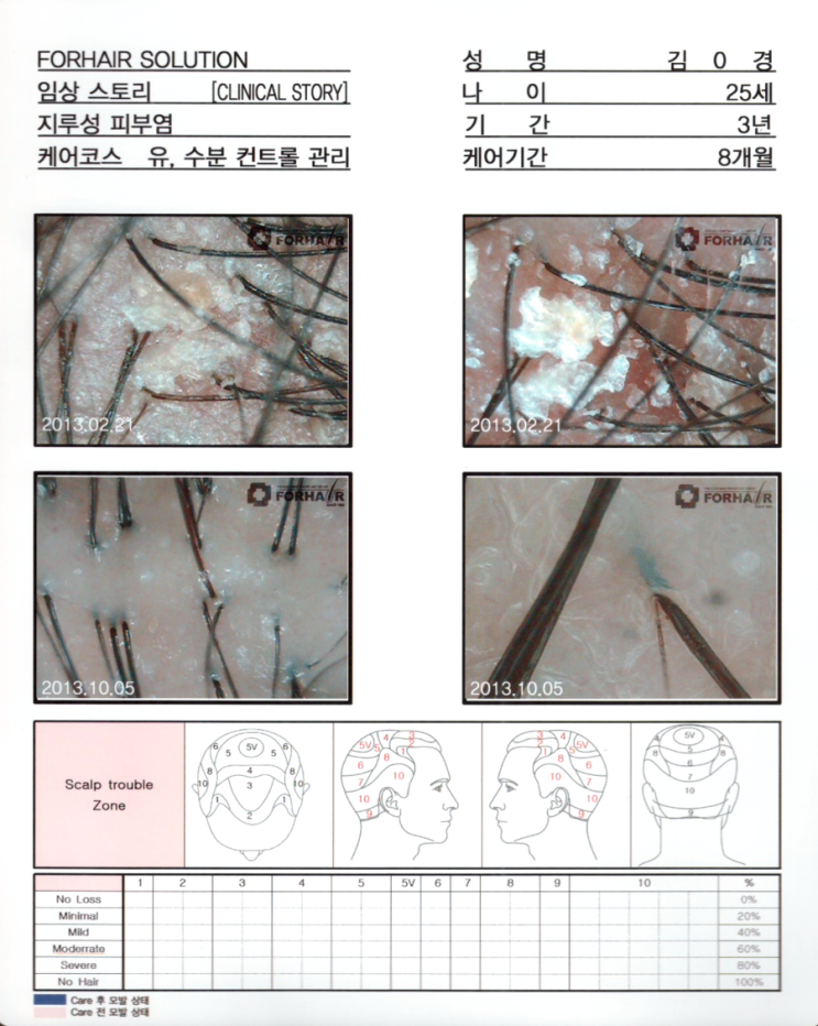 탈모기간3년, 유,수분 컨트롤관리 8개월 후 두피사진입니다.