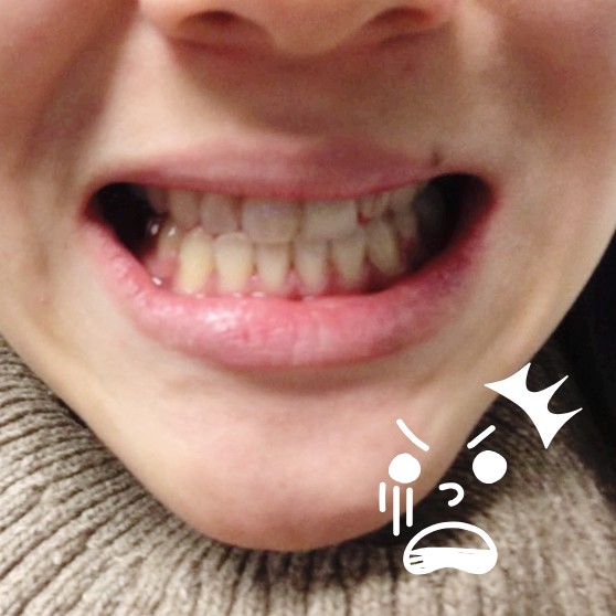 치아교정 20190110] +1359 43번째 월치료, 하악 치아교정기 제거 했으나 교합이 안맞다.? : 네이버 블로그