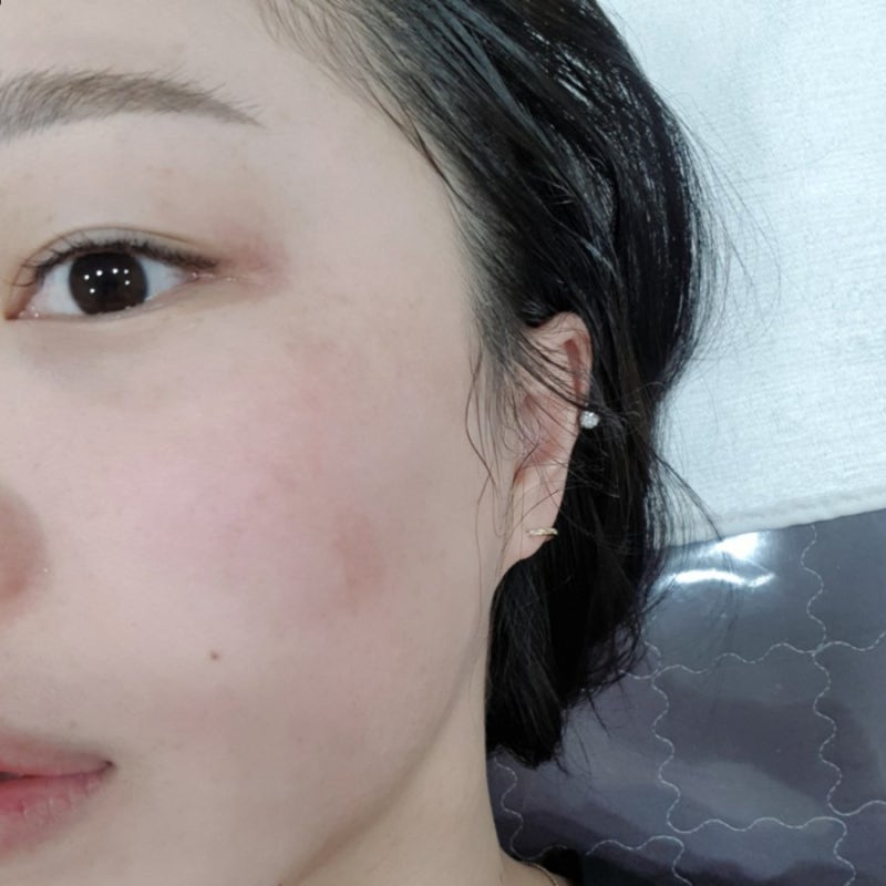 주근깨 및 잡티 제거제 리뷰