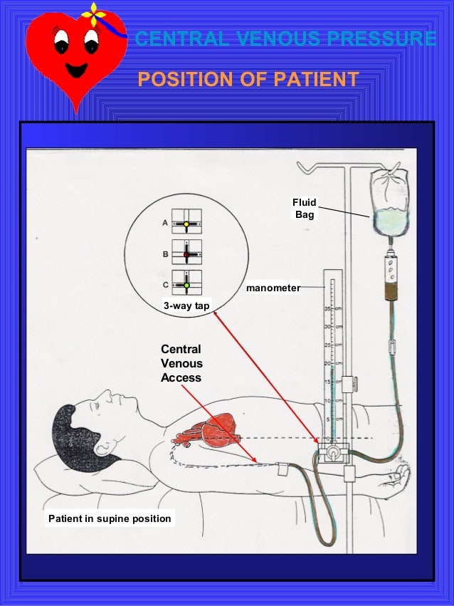 CVP ( Central Venous Pressure ) 중심정맥압 측정 : 네이버 블로그