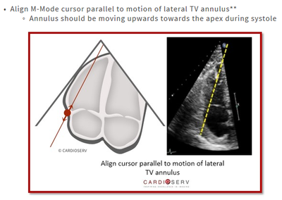우심실부전 (RV systolic dysfunction), RV failure : 네이버 블로그