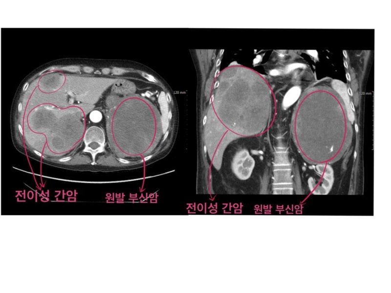 전이성 간암 (부신암 간전이) : 네이버 블로그