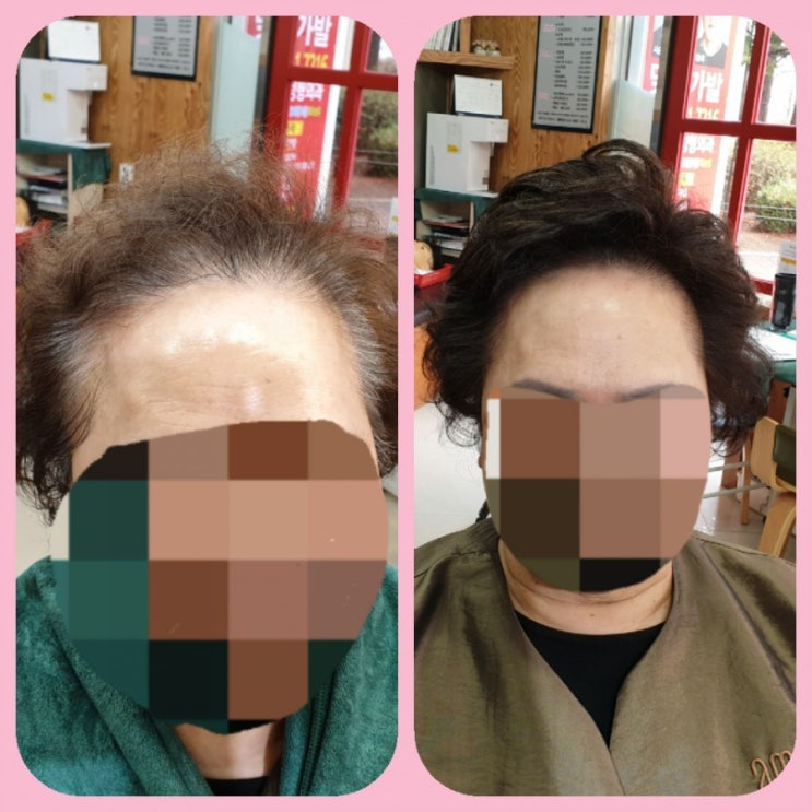  춘천가발 김호증모 이은주헤어살롱 부분탑가발로 노인성 탈모 및 흰머리 완벽 커버 하세요~^^