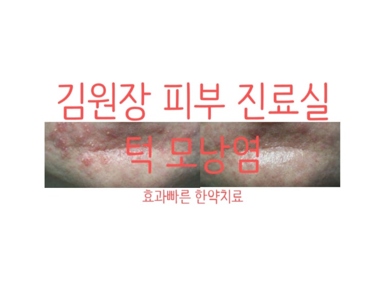  레이저치료, 연고 사용 후 생긴 턱 모낭염 한약치료 경과 케이스