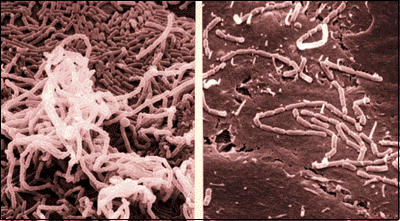 헤모필루스 듀크레이 궤양