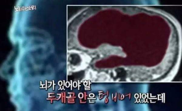  속보 문재앙 뇌사진 유츌