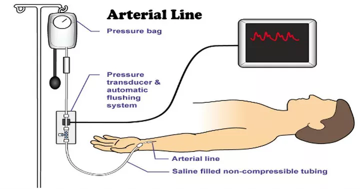 ECMO: ExtraCoporial Membrane Oxygenation : 네이버 블로그