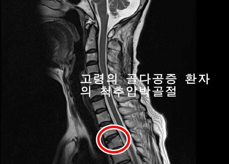  척추압박골절 후유장해 보상 손해사정