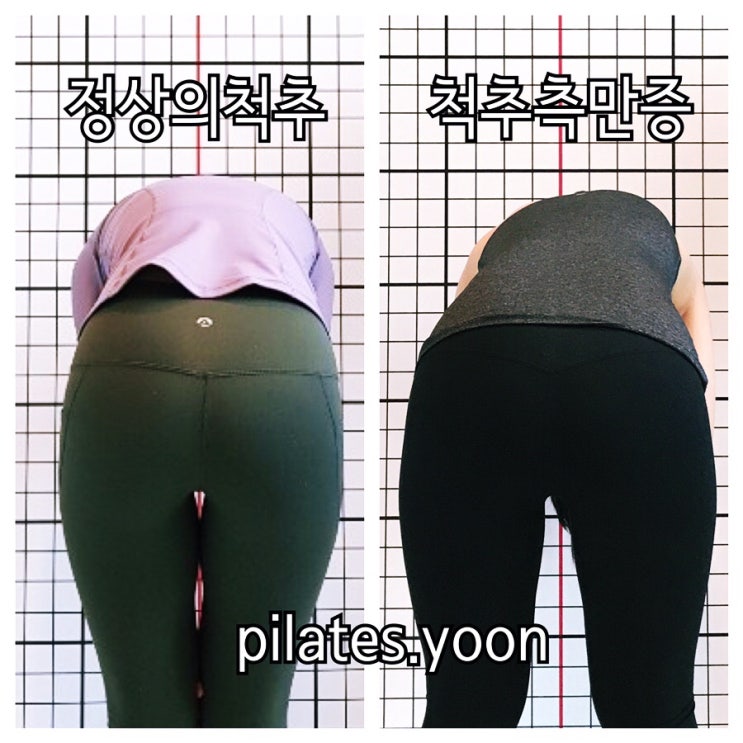  필라테스_척추측만증 척추옆굽음증/scoliosis