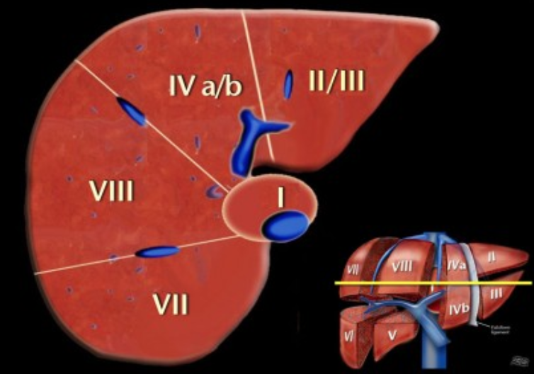 간 엽/분절 해부학(liver lobe/segment anatomy): CT 판독 Couinaud : 네이버 블로그