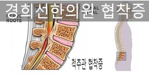  [동탄2청계동한의원][카림한의원]요통의 한방치료 허리협착증 통증