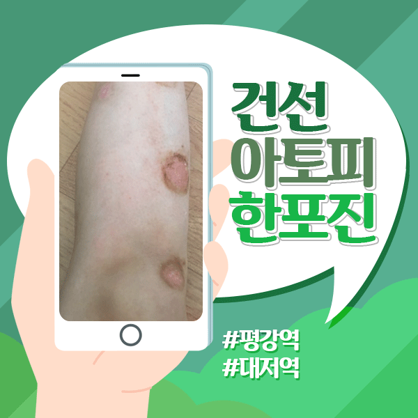  손톱건선 손톱무좀 헷갈리지말고 손톱건강 지키세요 :D