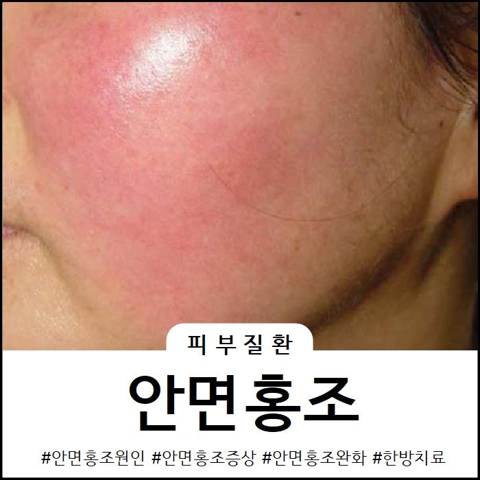  평택 안면홍조 증상을 완화시키고 싶다면?