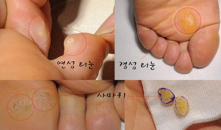 티눈 사마귀 구별 방법 '발바닥 · 발가락 실제 사진 보기'