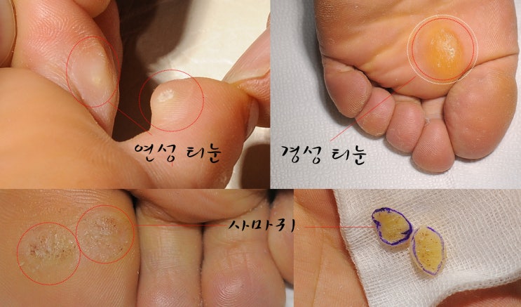  티눈 사마귀 구별 방법 '발바닥 · 발가락 실제 사진 보기'