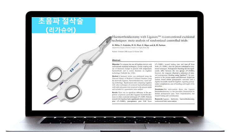  치질수술 통증 유/무는 조직절제 방법이 좌우한다