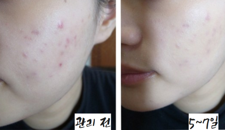  갈바닉 마시지기 부작용?2배 효과(보나플러스)사용법 추천!