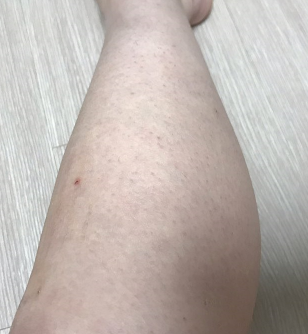  피부 오돌토돌 닭살 제거 도전기! :)