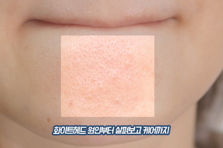  화이트헤드 원인 알아보고 해결까지 클리어