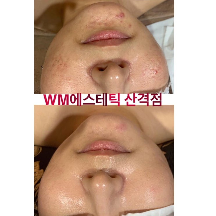  피부 확실한 변화를 느끼고 싶다면>>>더블유엠 산격점