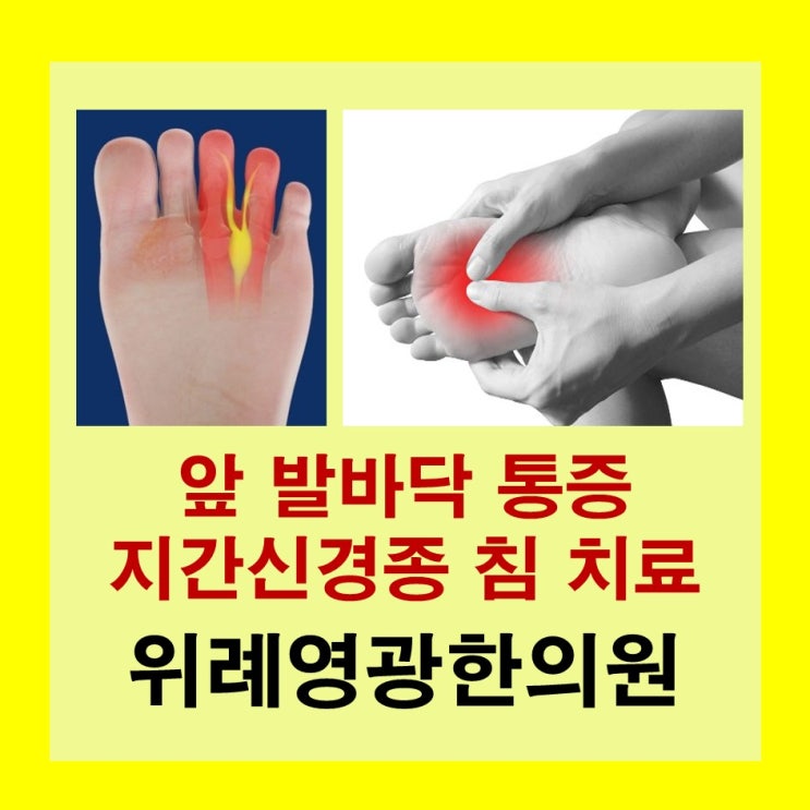  위례 송파 약침 한의원. "발바닥 앞쪽 통증" 지간신경종(Interdigital neuroma, Morton's neuroma) 증상 치료 침과 봉독주사, 약침으로 해결해 봅시다.