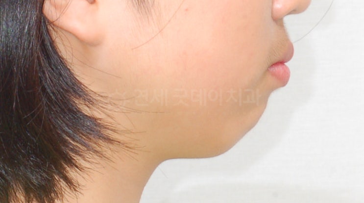  무턱돌출입 덧니부분교정 한계점 (턱선비교)