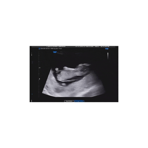  11W6D 거대자궁근종 임산부의 임신기. 1차 기형아 검사. 서울강남성모
